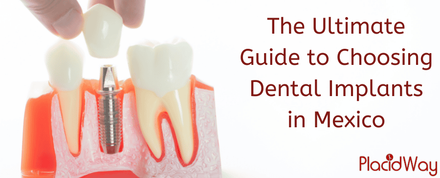 Dental Implants in Mexico