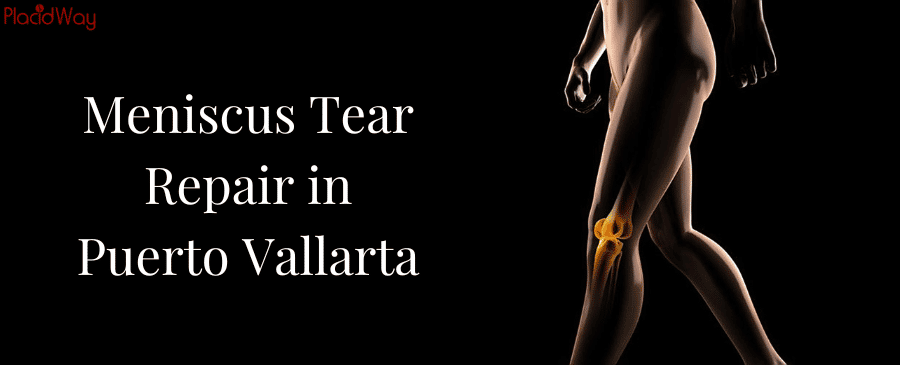 Meniscus Tear Repair in Puerto Vallarta, Mexico