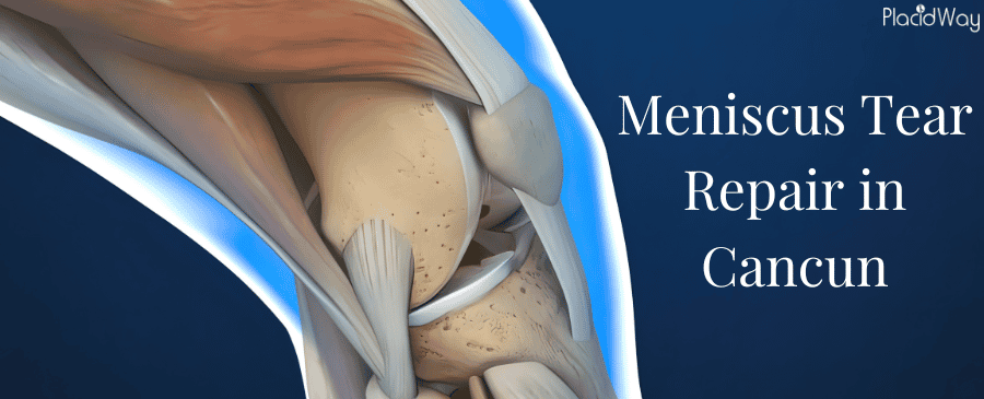 Meniscus Surgery in Cancun Mexico