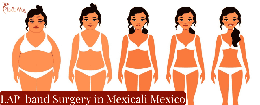 LAP-band Surgery in Mexicali Mexico