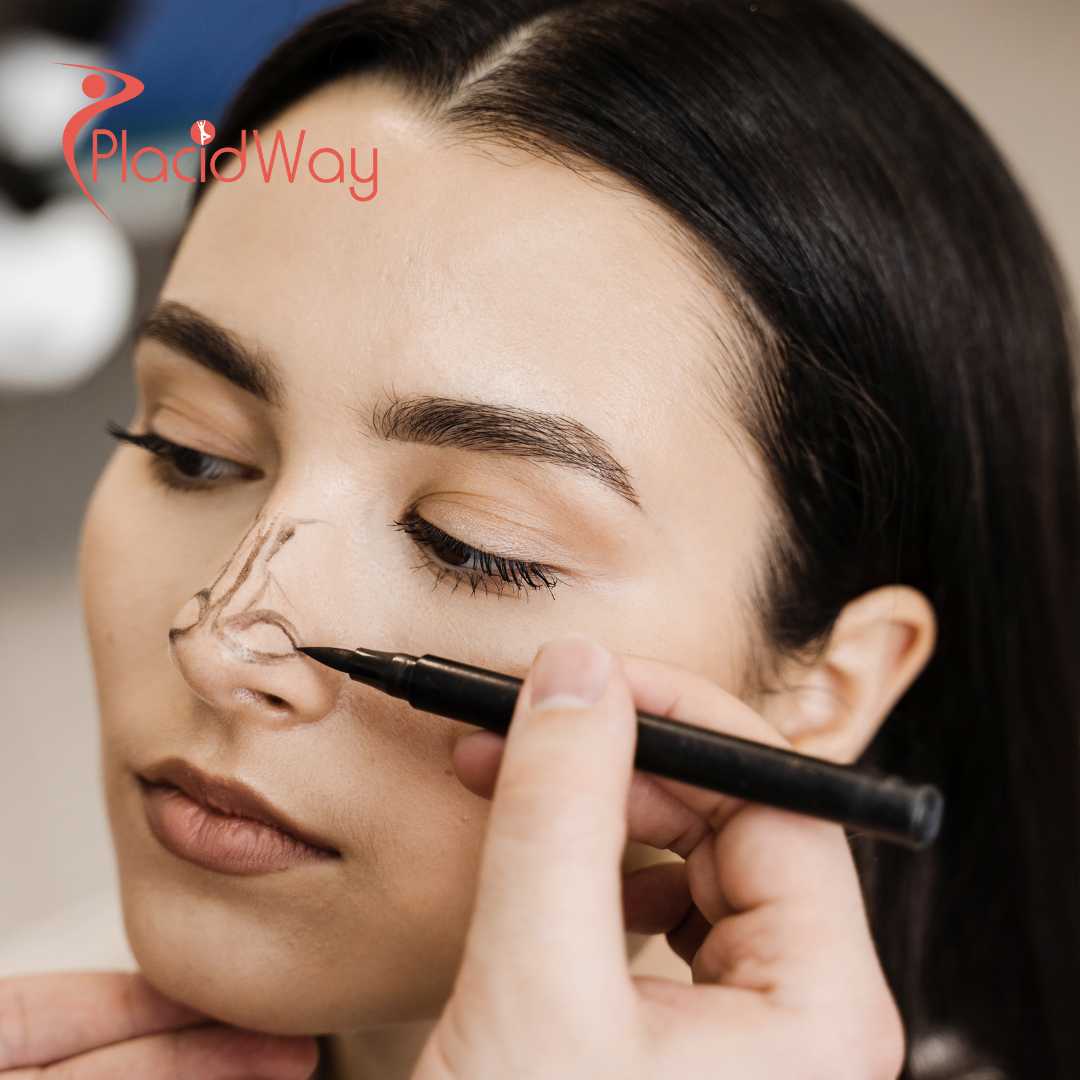 Revision Rhinoplasty in South Korea for Chinese Patients