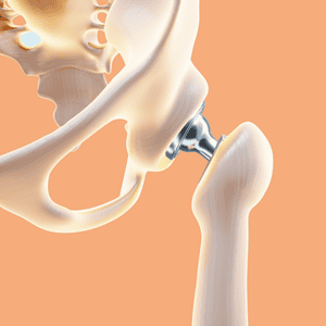 Hip Replacement in Cabo San Lucas, Mexico – Check Prices and Reviews!