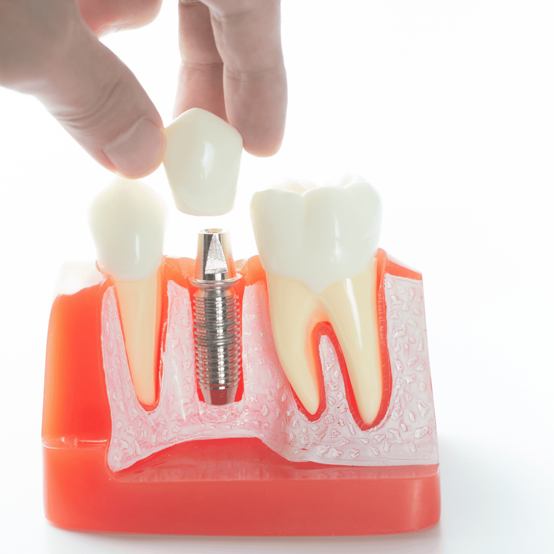 Dental Implants in Mexico