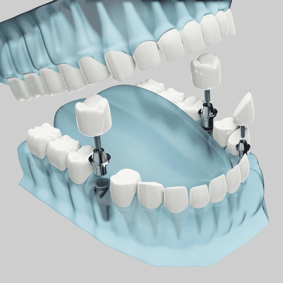 All on 4 Dental Implants in Cancun, Mexico