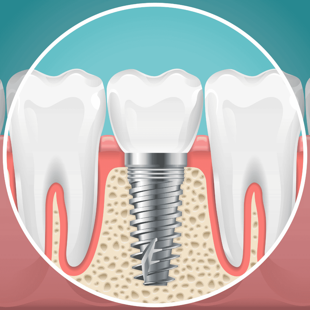 Dental Implants in Colombia - Affordable Tooth Replacement