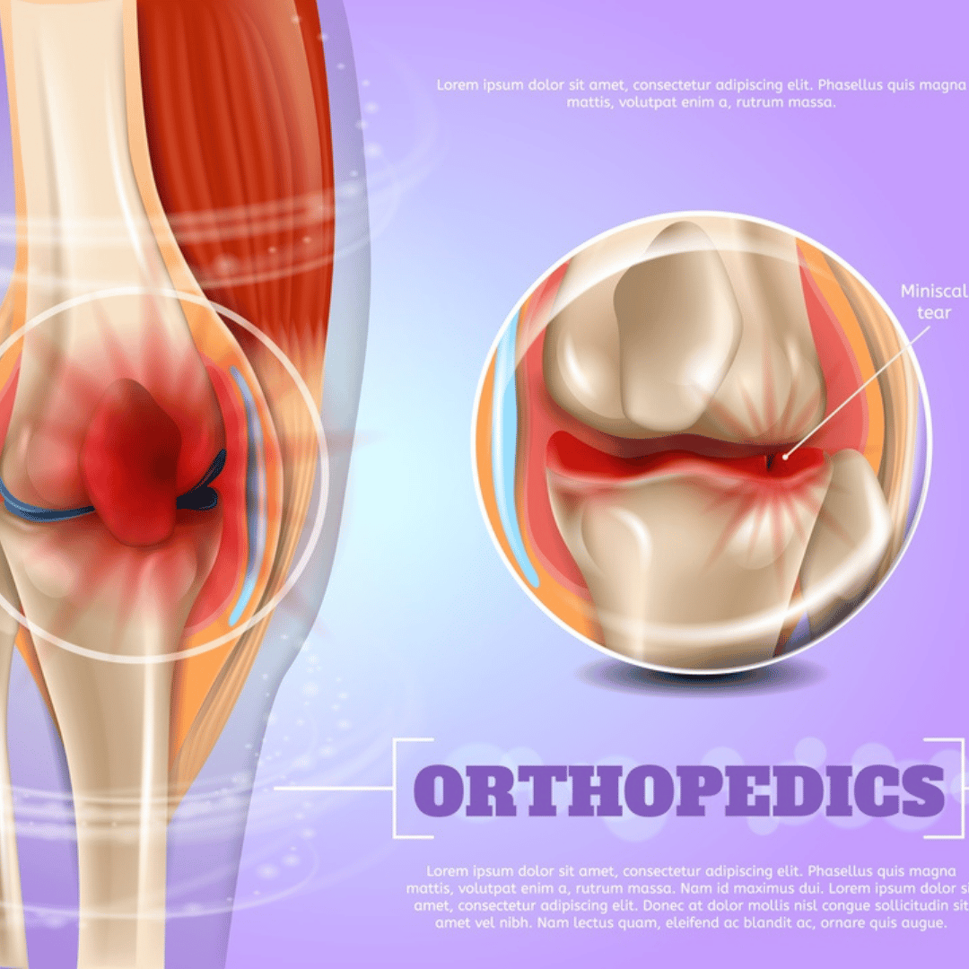 Meniscus Repair Procedure in Cabo San Lucas Mexico