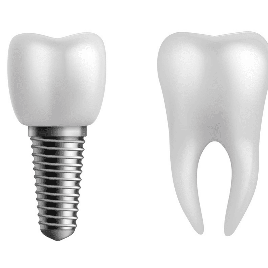 Affordable Package for Dental Implants in Zagreb, Croatia