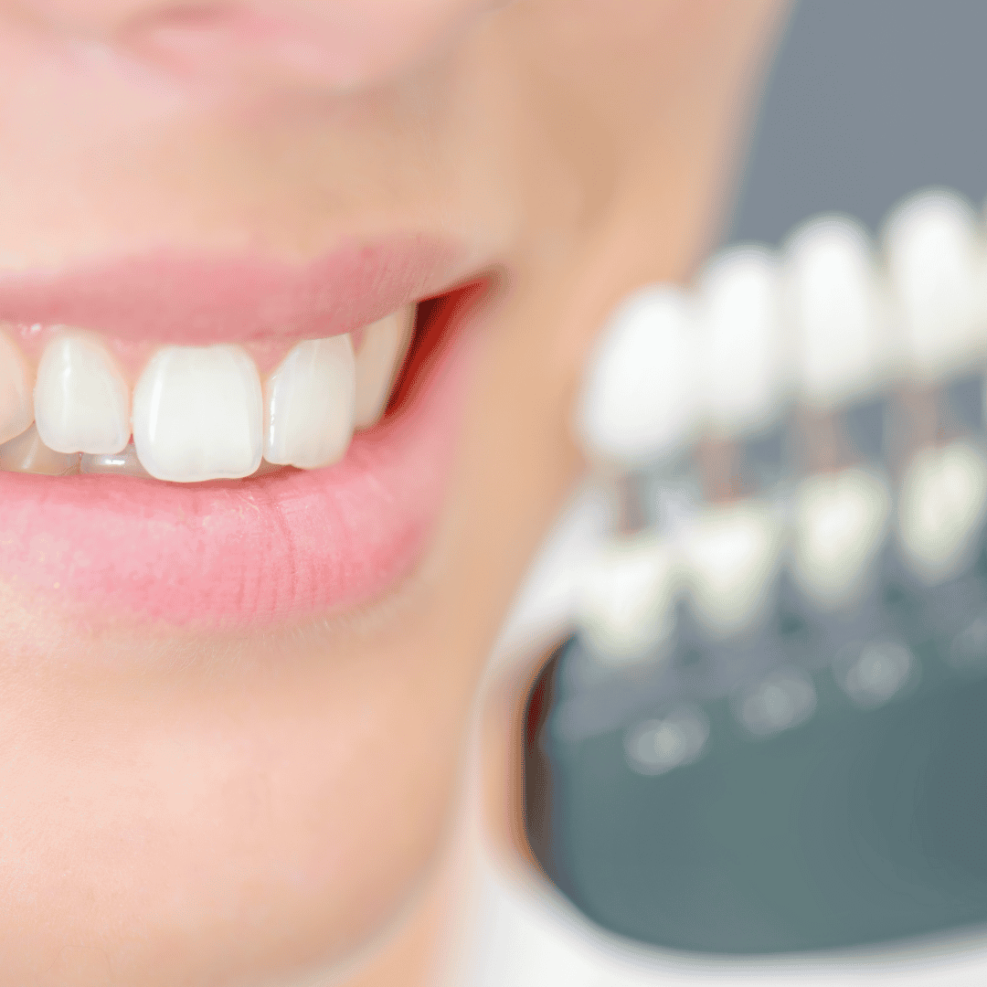 Affordable Package for Dental Veneers in Turkey