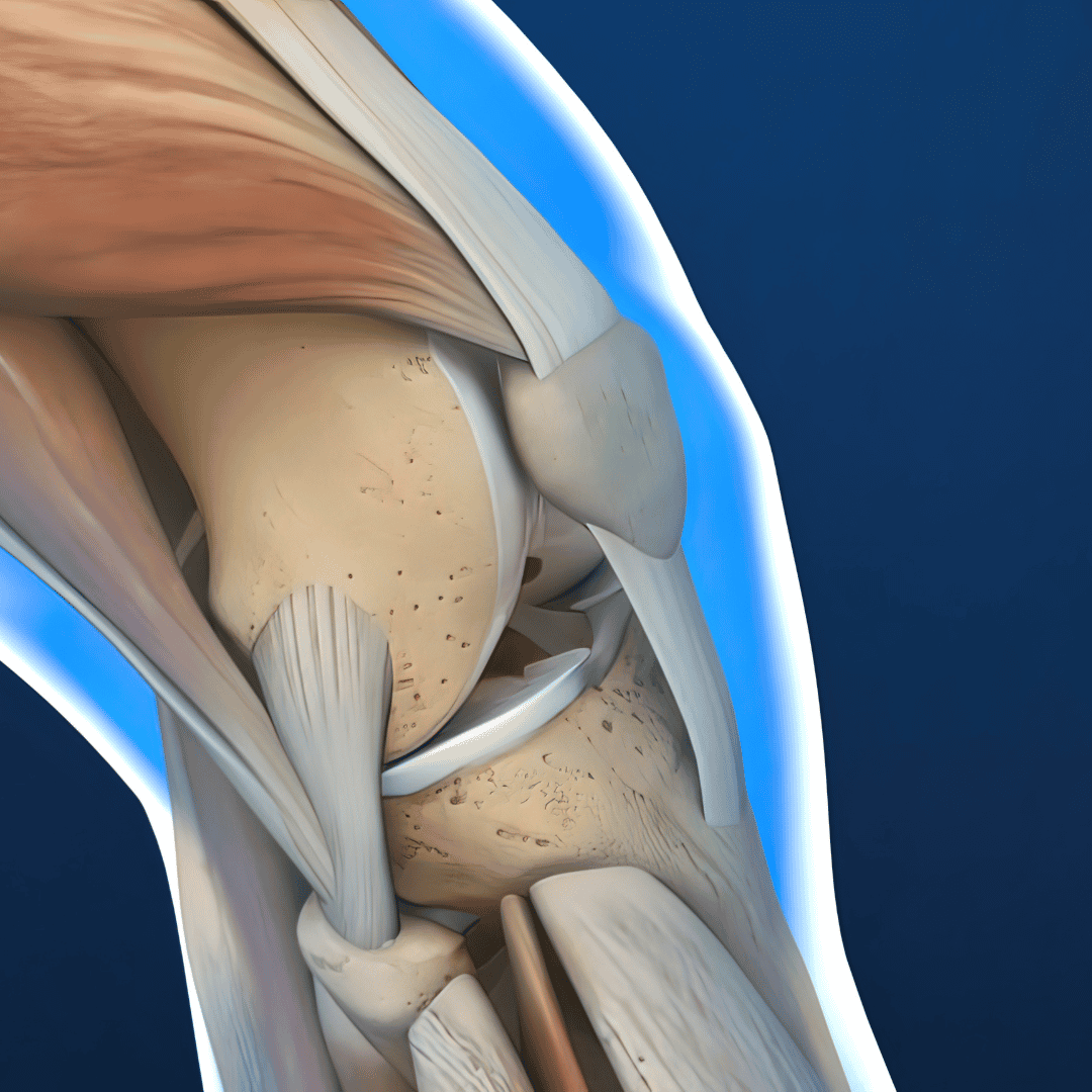 Top Package for Meniscus Repair in Nuevo Laredo, Mexico