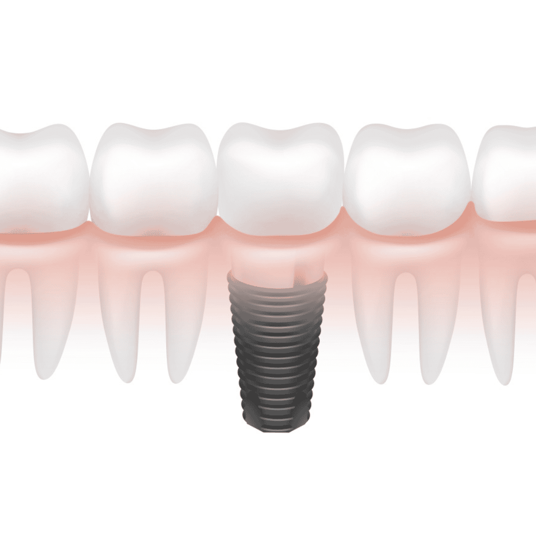 Cheap Package for Dental Implants in Cancun, Mexico