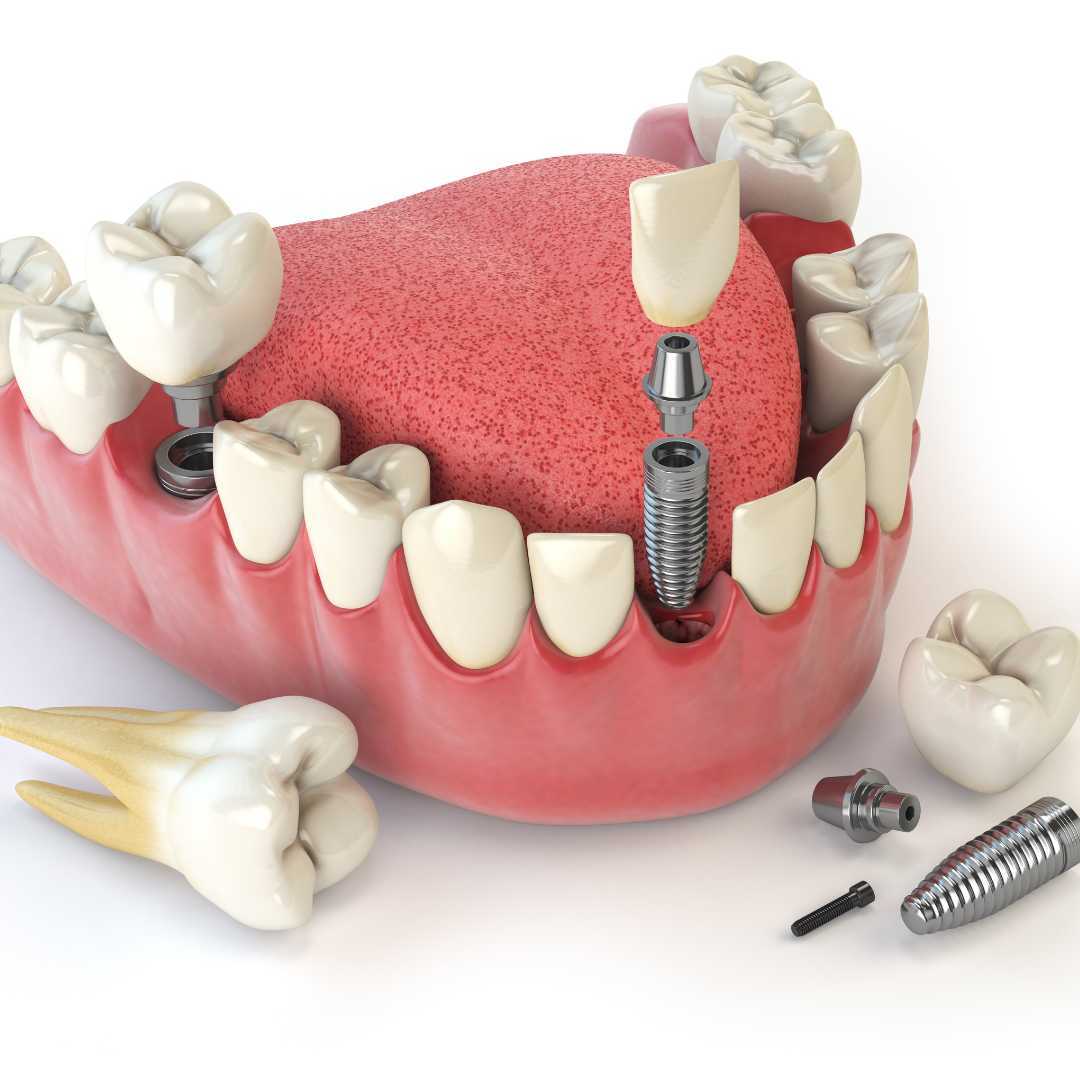 All on 4 Dental Implants Package in Tijuana, Mexico by Quality International Dental Clinic