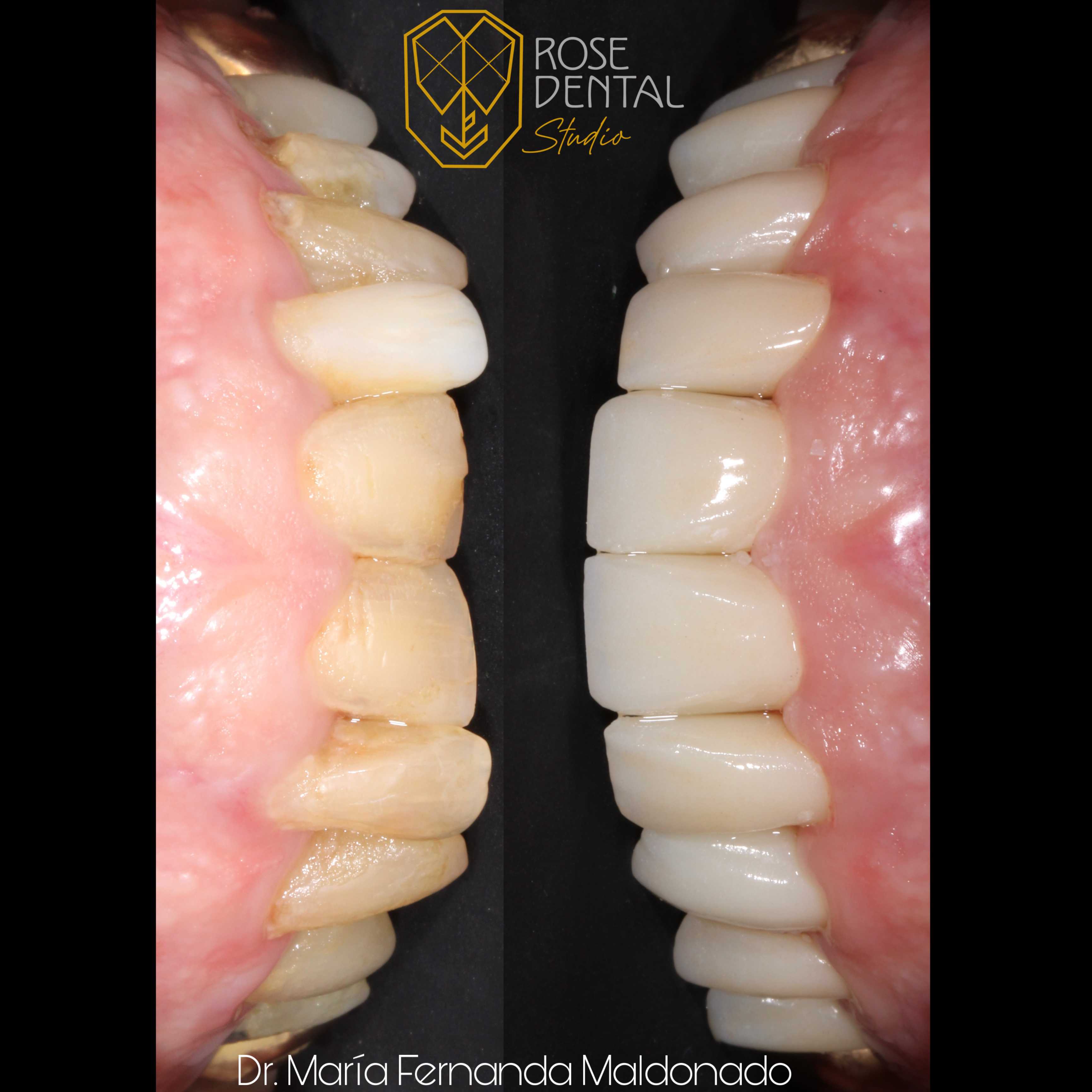 Dental Zirconium Crowns Package at Rose Dental Studio, Los Algodones, Mexico