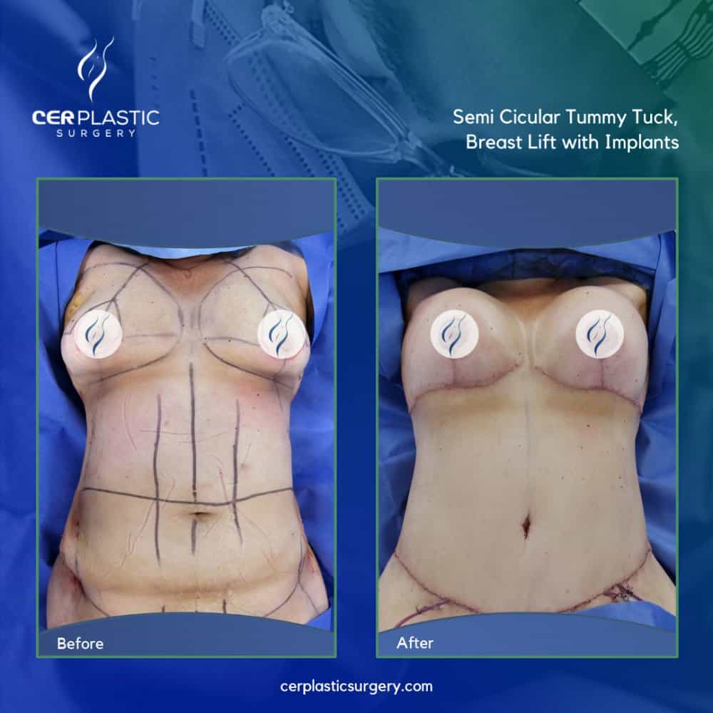 CER Plastic Surgery Tijuana