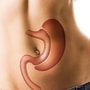 Affordable Gastric Sleeve Surgery Package in Tijuana, Mexico thumbnail