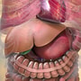 Gallbladder Removal Surgery Package in Merida, Mexico by Hernia Clinic thumbnail