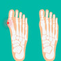 TURAN&TURAN Health Group,Hallux Valgus / Bunionectomy Surgery with LAPIDUS 3D Technology in Bursa/İstanbul, Turkey thumbnail