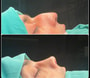 Rhinoplasty Package in Baku, Azerbaijan with Liv Bona Hospital thumbnail