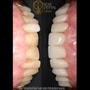 Dental Zirconium Crowns Package at Rose Dental Studio, Los Algodones, Mexico thumbnail